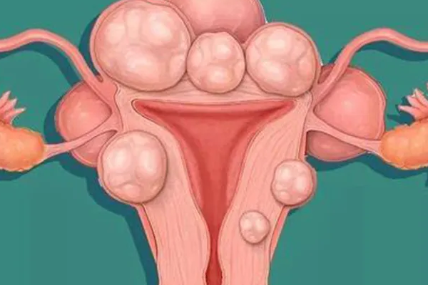 宫腔积液会不会影响第三代试管婴儿移植